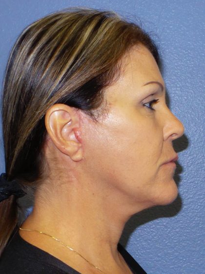 Facelift Before & After Patient #921