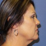 Facelift Before & After Patient #921