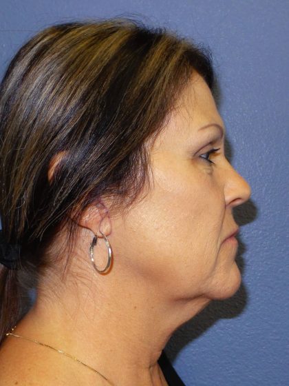 Facelift Before & After Patient #921