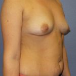 Breast Augmentation Before & After Patient #1675