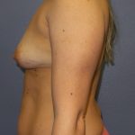 Breast Augmentation Before & After Patient #1675