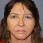 Facelift Before & After Patient #859