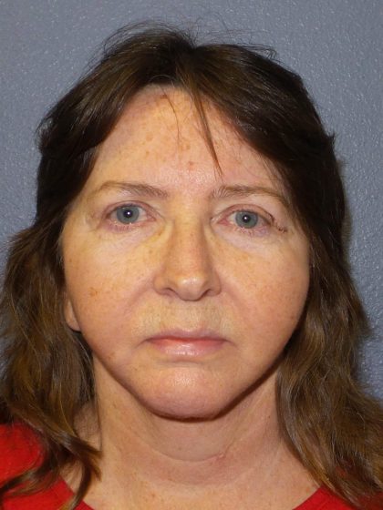 Facelift Before & After Patient #859
