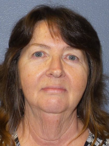 Facelift Before & After Patient #859