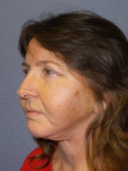 Facelift Before & After Patient #859