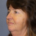 Facelift Before & After Patient #859