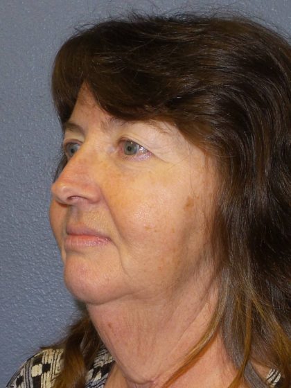 Facelift Before & After Patient #859