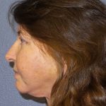 Facelift Before & After Patient #859