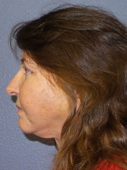Facelift Before & After Patient #859
