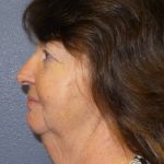 Facelift Before & After Patient #859