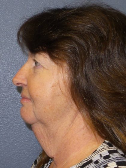 Facelift Before & After Patient #859