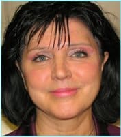 Facelift Before & After Patient #864