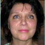 Facelift Before & After Patient #864