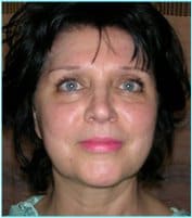 Facelift Before & After Patient #864