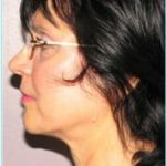 Facelift Before & After Patient #864