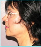 Facelift Before & After Patient #864