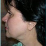 Facelift Before & After Patient #864