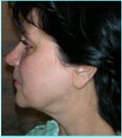 Facelift Before & After Patient #864
