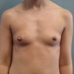 Breast Augmentation Before & After Patient #1458