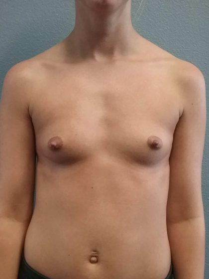 Breast Augmentation Before & After Patient #1458