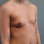 Breast Augmentation Before & After Patient #1458