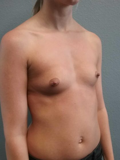Breast Augmentation Before & After Patient #1458