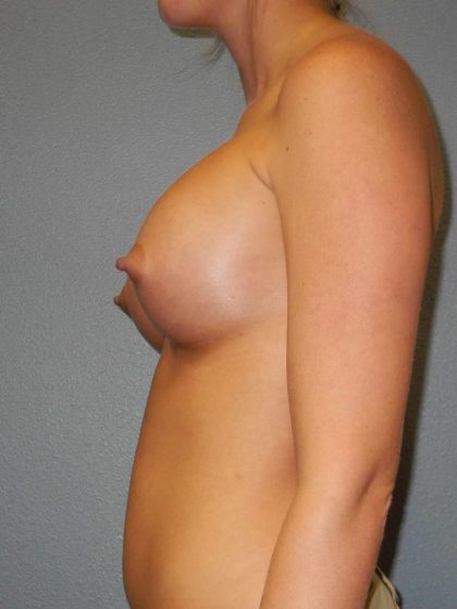Breast Augmentation Before & After Patient #1458