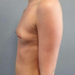 Breast Augmentation Before & After Patient #1458