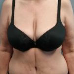 Abdominoplasty Before & After Patient #2163