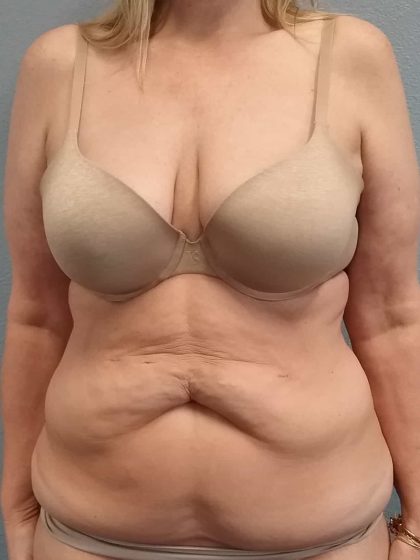 Abdominoplasty Before & After Patient #2163