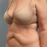 Abdominoplasty Before & After Patient #2163