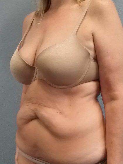 Abdominoplasty Before & After Patient #2163