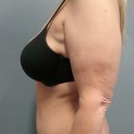 Abdominoplasty Before & After Patient #2163