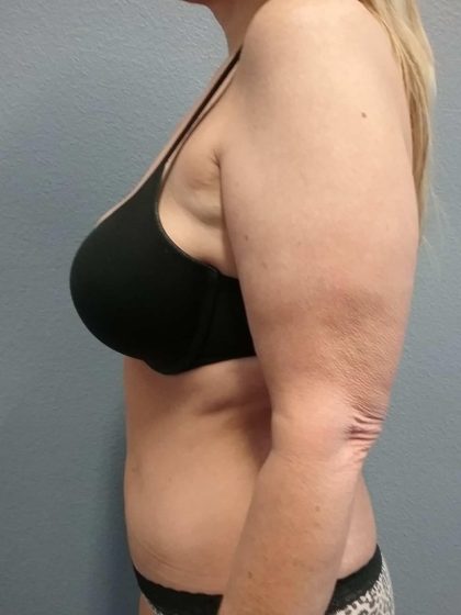 Abdominoplasty Before & After Patient #2163
