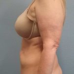 Abdominoplasty Before & After Patient #2163