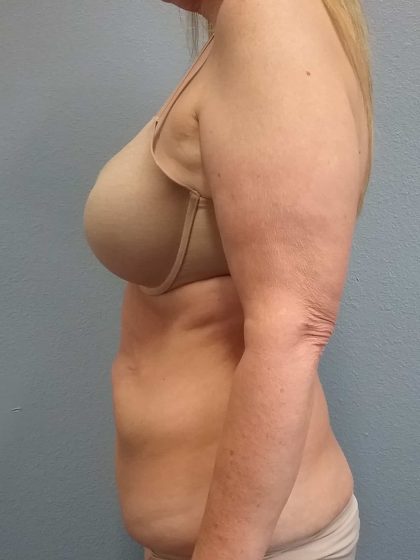Abdominoplasty Before & After Patient #2163