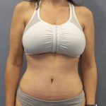 Abdominoplasty Before & After Patient #2188