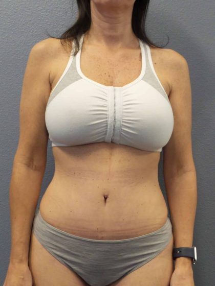 Abdominoplasty Before & After Patient #2188