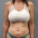 Abdominoplasty Before & After Patient #2188