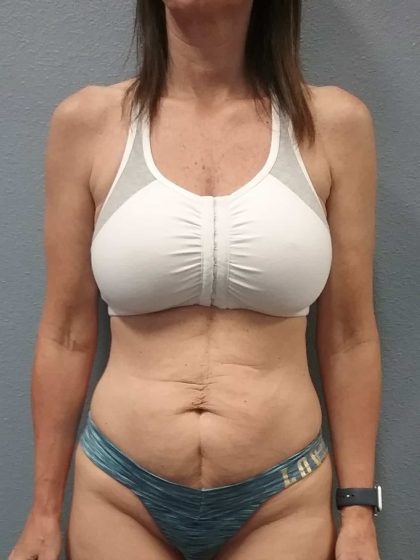 Abdominoplasty Before & After Patient #2188