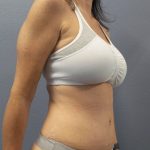 Abdominoplasty Before & After Patient #2188