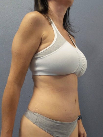 Abdominoplasty Before & After Patient #2188