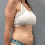 Abdominoplasty Before & After Patient #2188