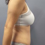 Abdominoplasty Before & After Patient #2188