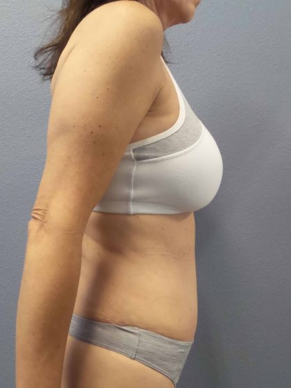 Abdominoplasty Before & After Patient #2188