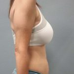 Abdominoplasty Before & After Patient #2188