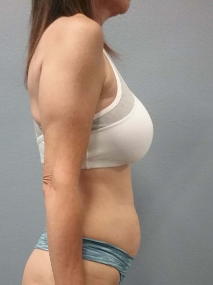 Abdominoplasty Before & After Patient #2188
