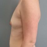 Breast Augmentation Before & After Patient #1556