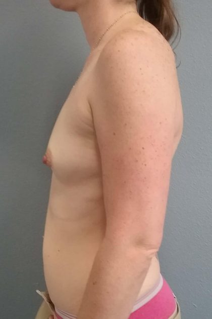Breast Augmentation Before & After Patient #1556