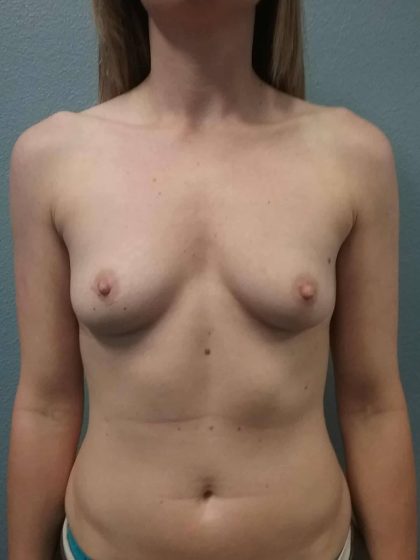 Breast Augmentation Before & After Patient #1506